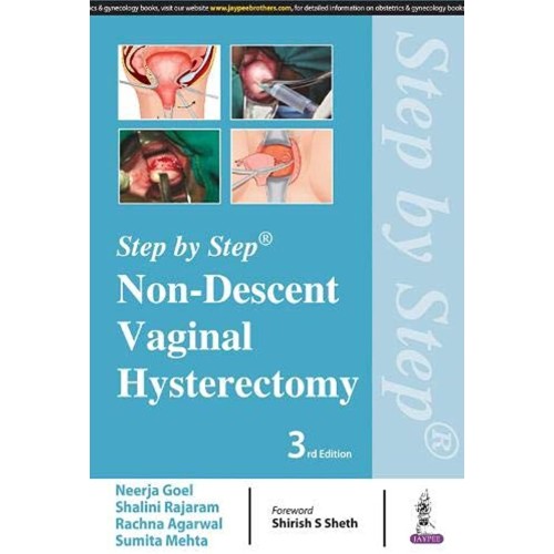 STEP BY STEP NON-DESCENT VAGINAL HYSTERECTOMY