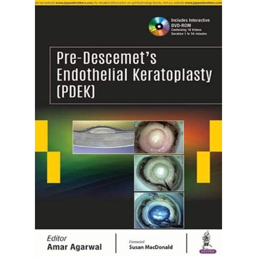 PRE-DESCEMET'S ENDOTHELIAL KERATOPLASTY(PDEK)