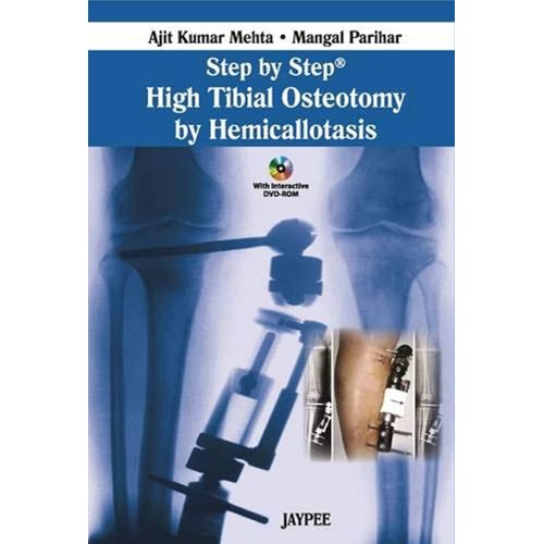 STEP BY STEP HIGH TIBIAL OSTEOTOMY BY HEMICAL...