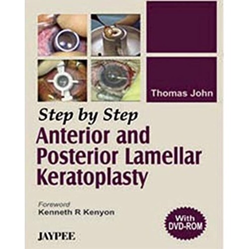 STEP BY STEP ANTERIOR AND POSTERIOR LAMELLAR ...