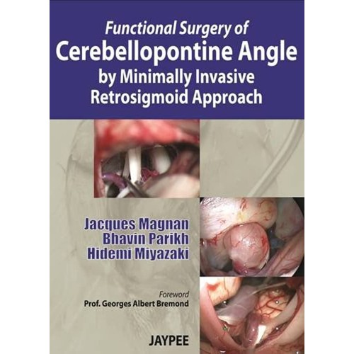 FUNCTIONAL SURGERY OF CEREBELLOPONTINE ANGLE BY MINIMALLY INVASIVE RETROSIGMOID APPROACH