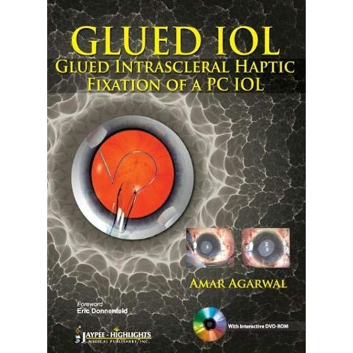 GLUED IOL GLUED INTRASCLERAL HAPTIC FIXATION OF A PC IOL WITH DVD-ROM