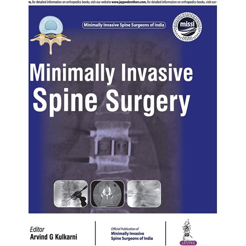 MINIMALLY INVASIVE SPINE SURGERY(OFFICIAL PUBLICATION OF MINIMALLY INVASIVE SPINE SURGEONS OF INDIA)