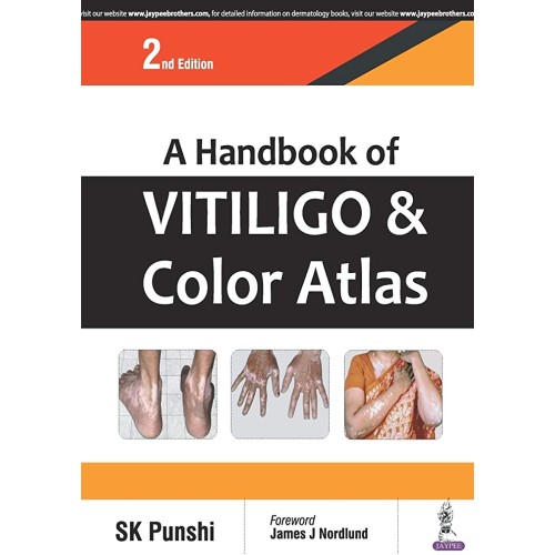 A HANDBOOK OF VITILIGO & COLOR ATLAS