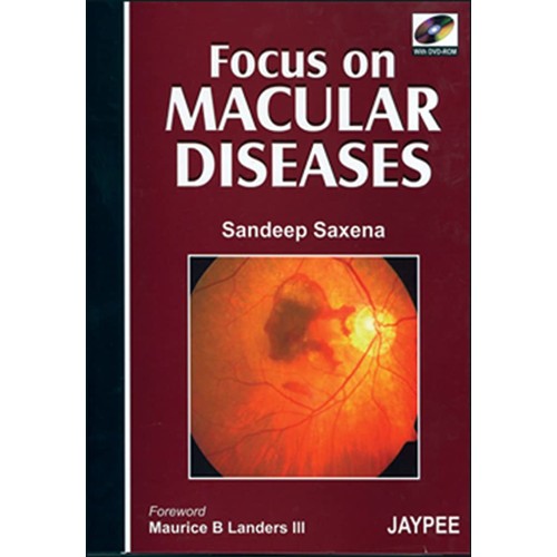 FOCUS ON MACULAR DISEASES WITH DVD-ROM