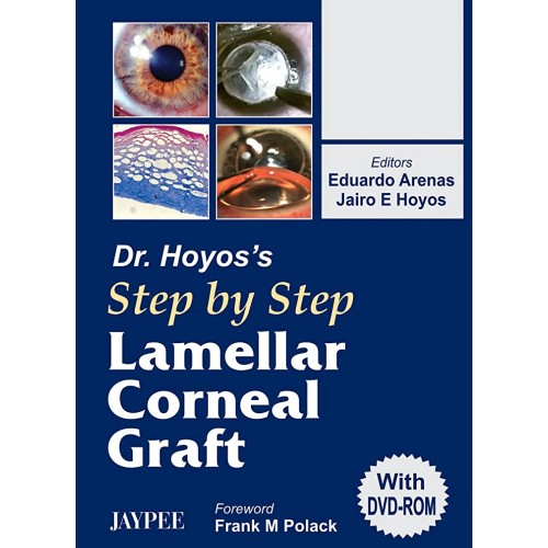 DR.HOYOS' STEP BY STEP LAMELLAR CORNEAL GRAFT WITH DVD-ROM