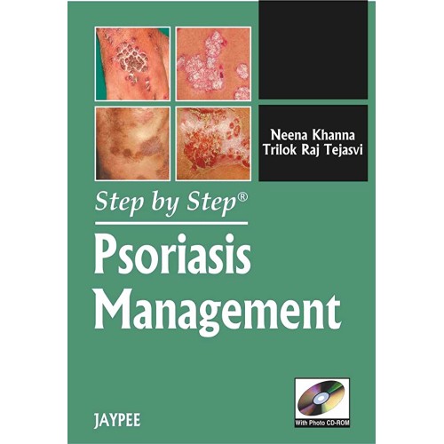 STEP BY STEP PSORIASIS MANAGEMENT WITH PHOTO ...