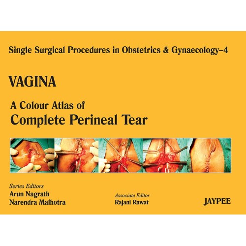 VAGINA-4:A.C.A.OF COMPLETE PERINEAL TEAR (SSP...