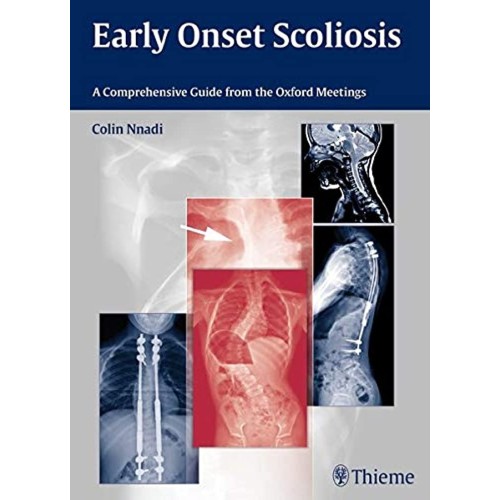 Early Onset Scoliosis A Comprehensive Guide from the Oxford Meetings 1st Ed