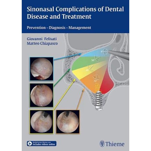 Sinonasal Complications of Dental Disease and...