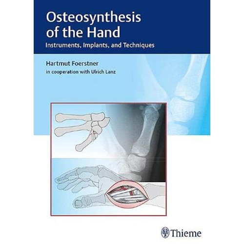 Osteosynthesis of the Hand : Instruments, Imp...