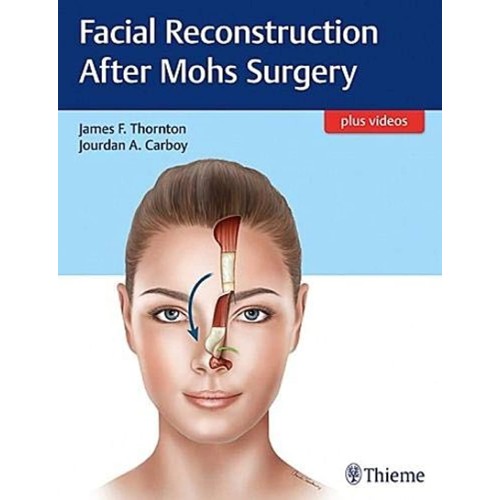 Facial Reconstruction After Mohs Surgery 1st Ed.