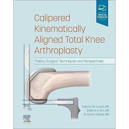 Calipered Kinematically aligned Total Knee Arthroplasty-1E