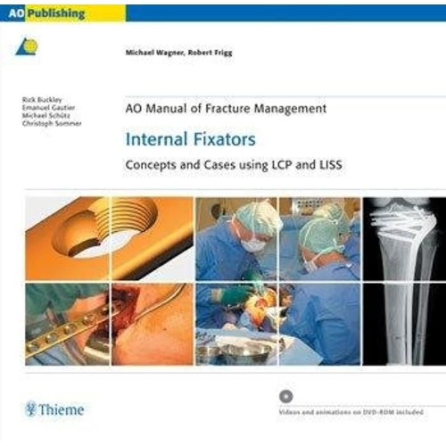 AO Manual of Fracture Management Internal Fix...