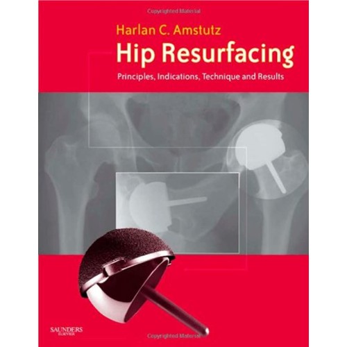 Hip Resurfacing