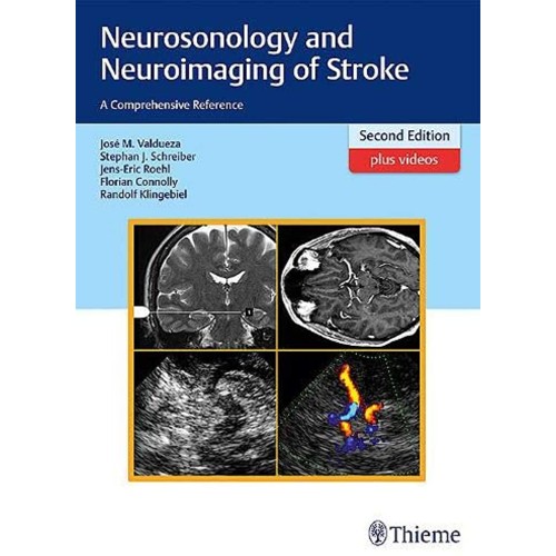 Neurosonology and Neuroimaging of Stroke 2nd Edition