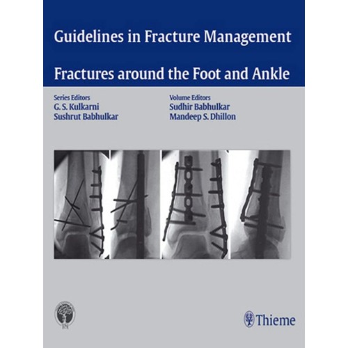 Fracture Around the Foot and Ankle