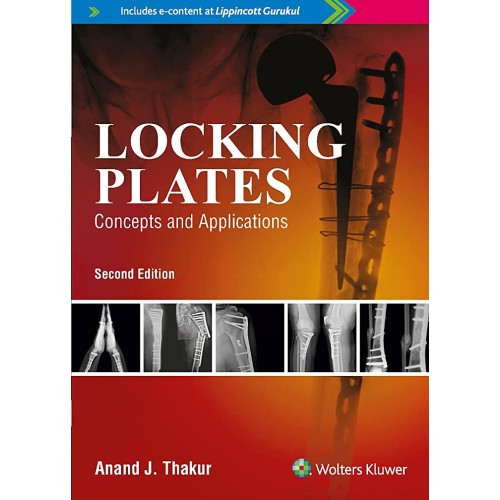 Locking Plates Concepts and Applications -2E