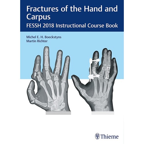 Fractures of the Hand and Carpus Fessh 2018 Instructional Course Book