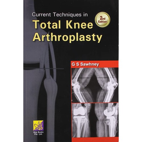 Current Techniques in Total Knee Arthroscopy - 2E