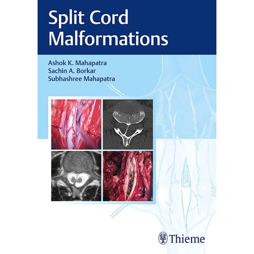 Split Cord Malformations 1st Ed.